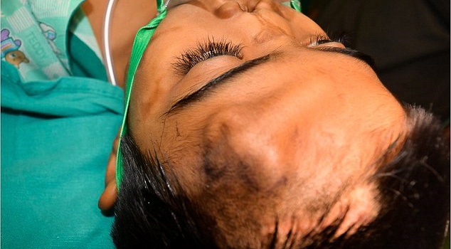 Индийские врачи "вырастили" новый нос мальчика у него на лбу