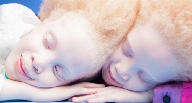 Близнецы-альбиносы из Бразилии покорили Интернет
