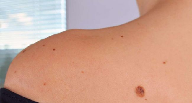 Это вам поможет: врачи рассказали о первых симптомах рака кожи 