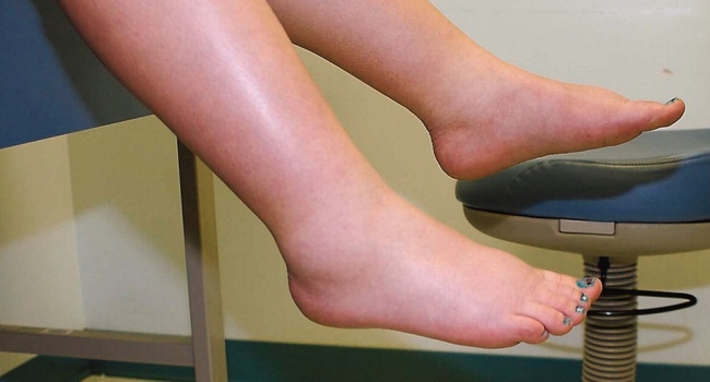 Медики: отеки ног могут свидетельствовать о тяжелейших заболеваниях