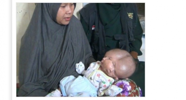 Индонезийка родила младенца с двумя лицами