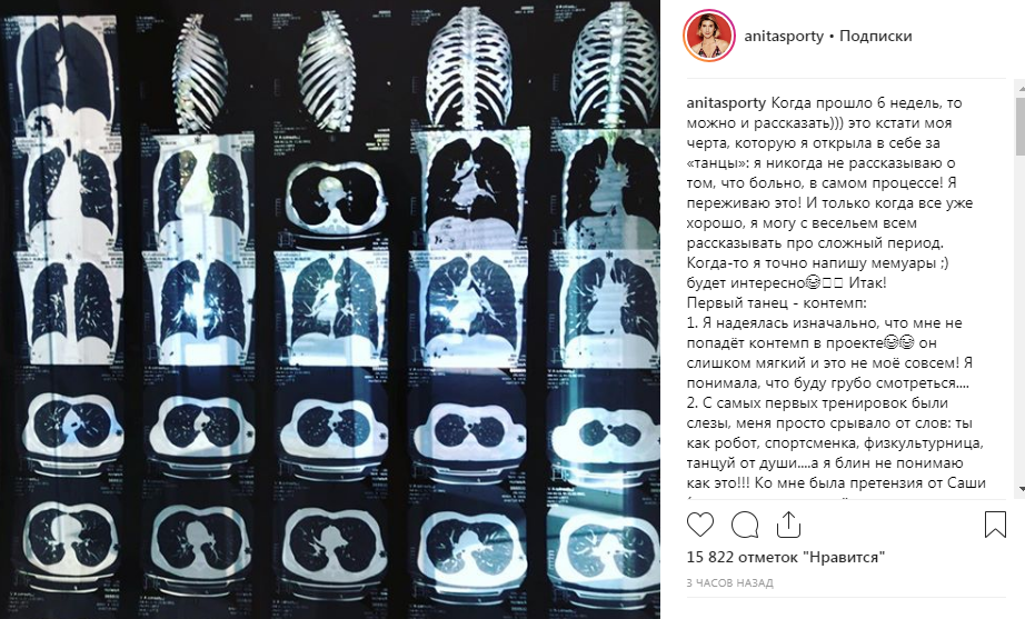 Опухшие ребра, закрытая травма грудной клетки и синяки: Анита Луценко написала правду об участии в шоу «Танцы со звездами»