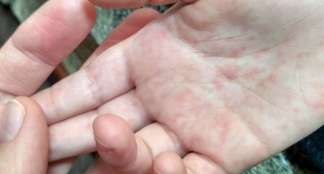 Во Львове скончался трехлетний ребенок из-за осложнений от кори