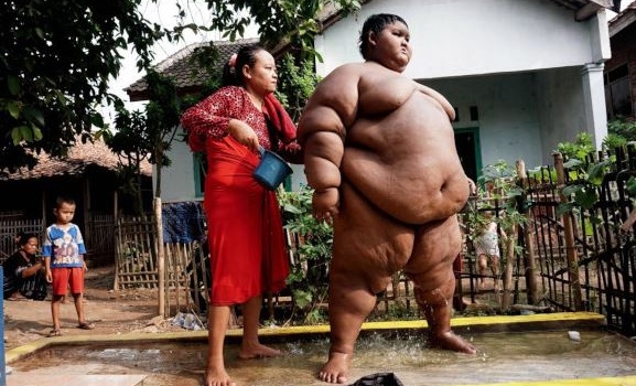  Индонезийский подросток похудел на 100 кг