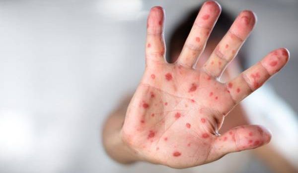 Эпидемия кори в Украине: за неделю заболел 261 человек 