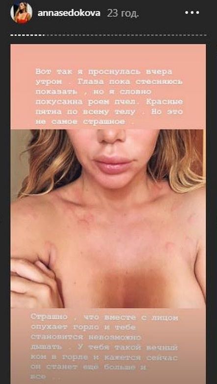 «Всему виной стресс»: Анна Седокова напугала поклонников странными изменениями во внешности 