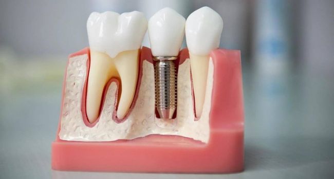 Зубные импланты: особенности установки и порядок цен 