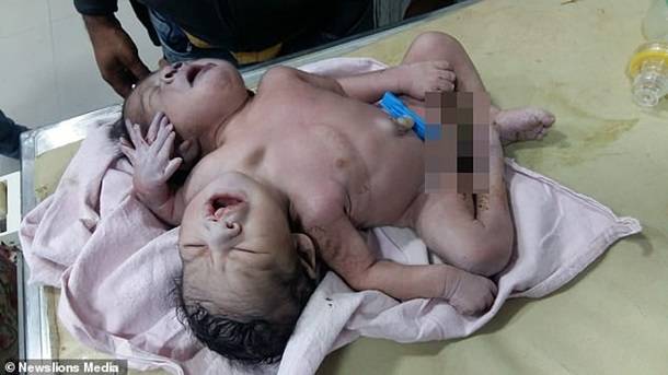 В Индии родился двухголовый ребенок с тремя руками