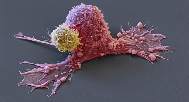 Рак кишечника можно распознать: Учёные рассказали о новом открытии