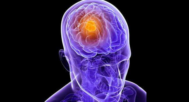 Напоминает процесс старения: Учёные назвали ещё один симптом опухоли мозга 