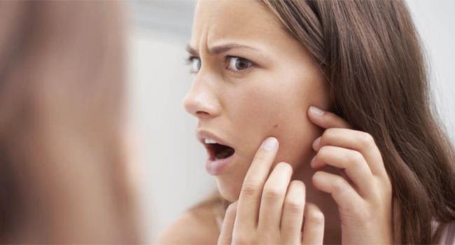 Гормоны, щитовидка и неправильное питание: Медики рассказали, о чём сигнализируют прыщи на лице 