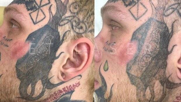 Сын Елены Яковлевой решил свести татуировки со своего лица