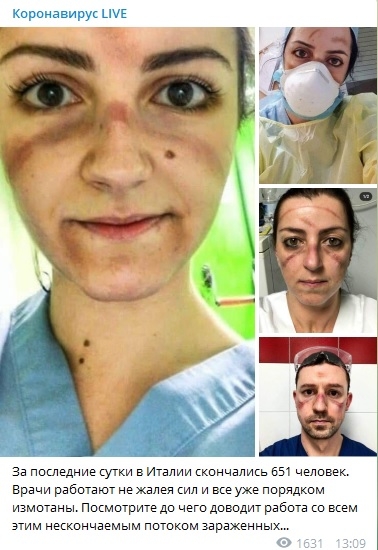 «Ужас, все лицо в синяках!»: Появились фото измотанных врачей Италии, которые помогают инфицированным коронавирусом людям