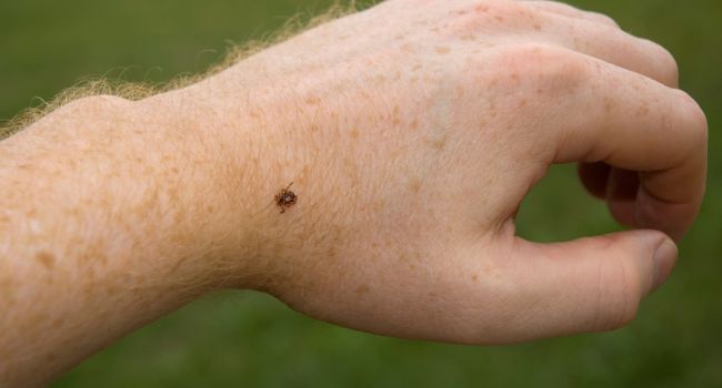 Сезон клещей уже близко: медик рассказала, как самостоятельно извлечь насекомое