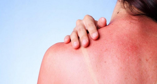 Медики назвали главные причины аллергии на солнечные лучи