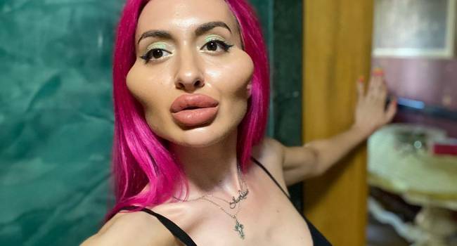 «Я себя обожаю. Ну, так мне хотелось себя усовершенствовать»: украинская блогерша стала единственной женщиной в мире с самыми большими скулами 