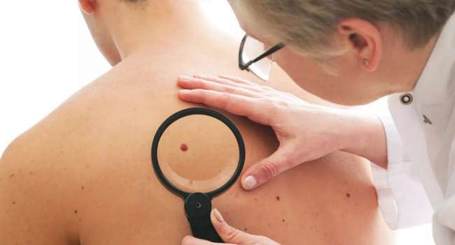 Дерматолог назвала категорию людей с высоким риском рака кожи 