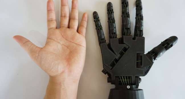 Во Львове пациенту установили напечатанный на 3D-принтере протез руки